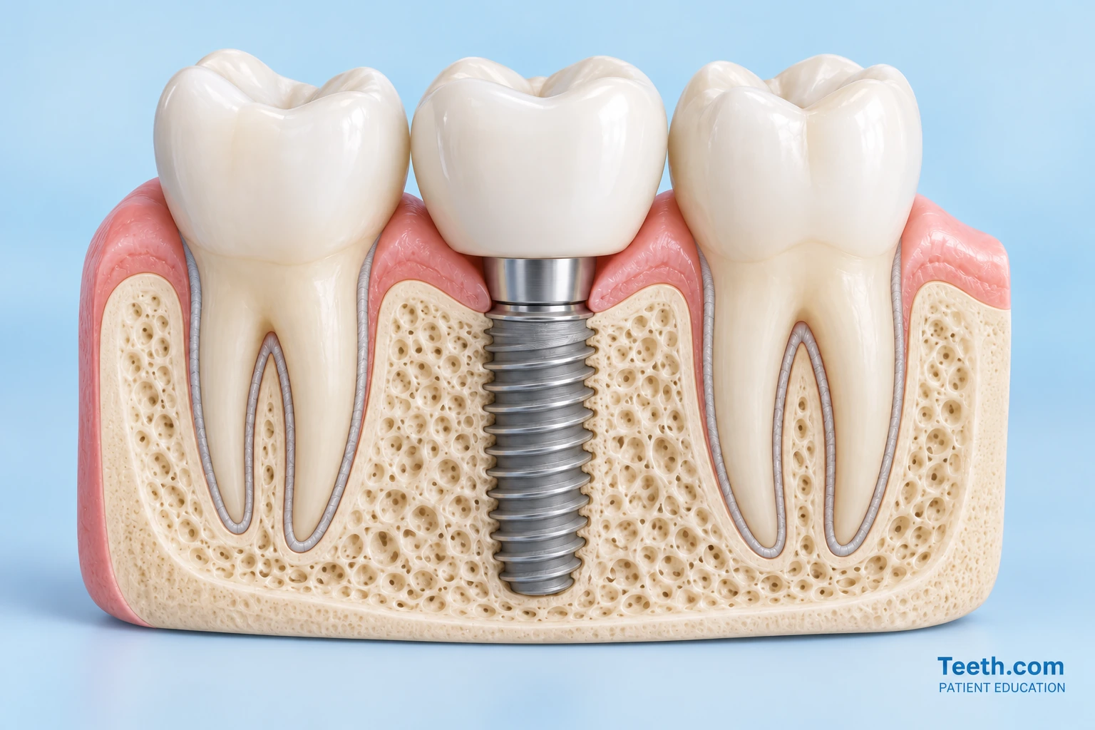 Simplified illustration of one implant-supported crown between two natural teeth
