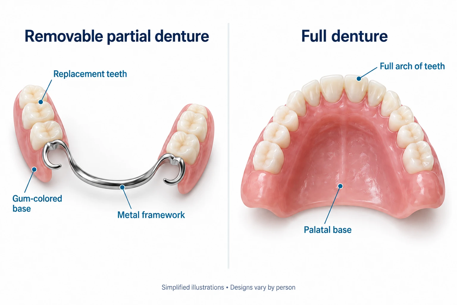 Labeled simplified illustrations of a lower removable partial denture with replacement teeth, pink bases and metal framework, beside a full upper denture with palatal coverage