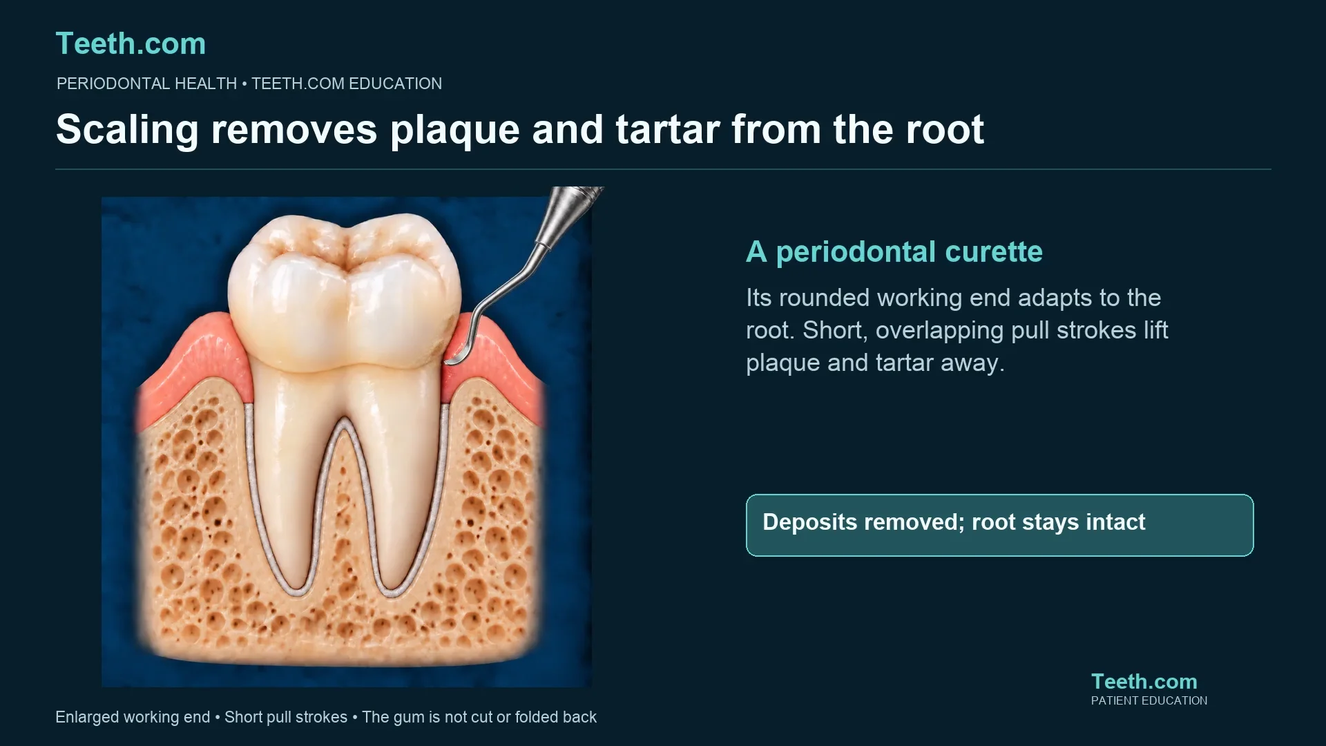 A periodontal curette beside a root surface, showing professional deposit removal without a surgical flap